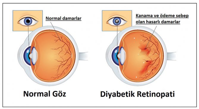 diabetik1.jpg